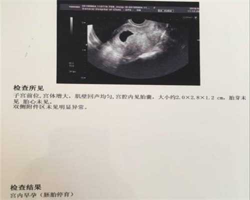 广州代孕包选性别价格_必须选择剖腹产的七种情况