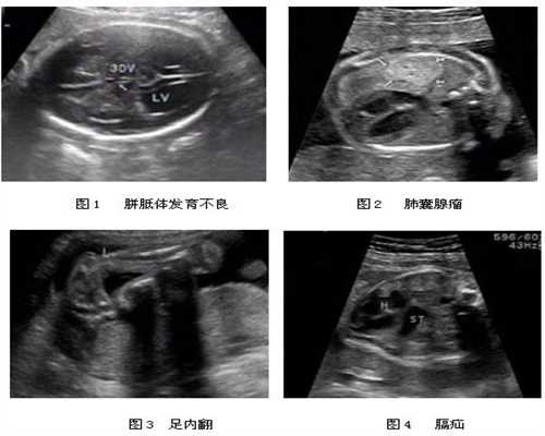 广州代孕选性别包成功价格_孕妇血压低怎么办 加强营养多补气血