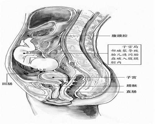 广州找个代孕的女人_怀孕早期死胎的症状有哪些